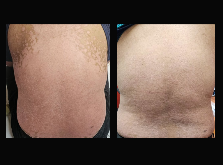 Before and after biologic treatment for psoriasis in Kedah: severe psoriasis on the back before tildrakizumab (left) and nearly clear skin after treatment (right)